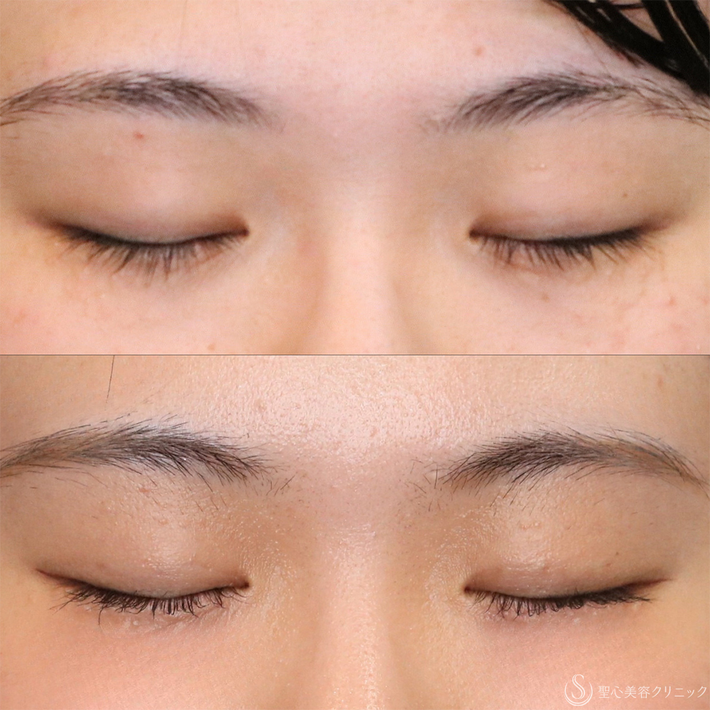 【20代女性・左右差を整える】二重埋没法（マイクロメソッド+α）（1ヶ月後） After 名古屋・二重整形