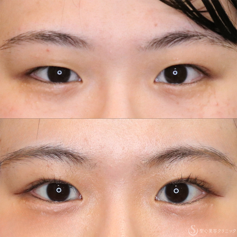 【20代女性・左右差を整える】二重埋没法（マイクロメソッド+α）（1ヶ月後） After 名古屋・二重整形