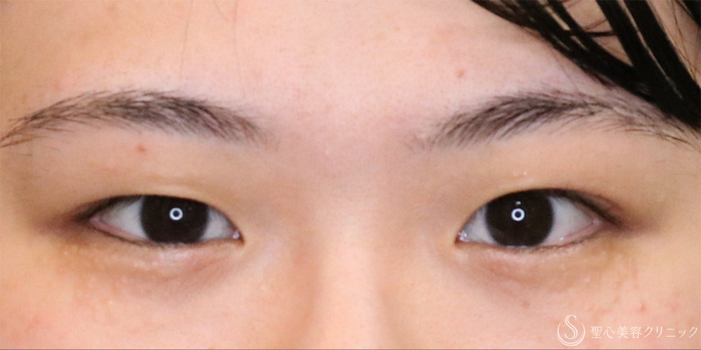 【20代女性・左右差を整える】二重埋没法（マイクロメソッド+α）（1ヶ月後） Before 