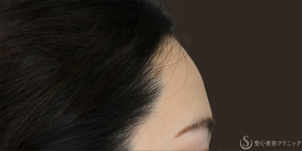 【30代女性・丸みのある額】プレミアムPRP皮膚再生療法（6年経過） Before 