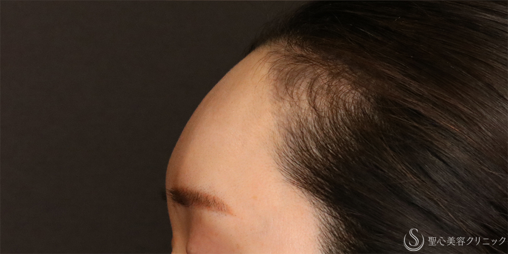 【30代女性・丸みのある額】プレミアムPRP皮膚再生療法（6年経過） After 
