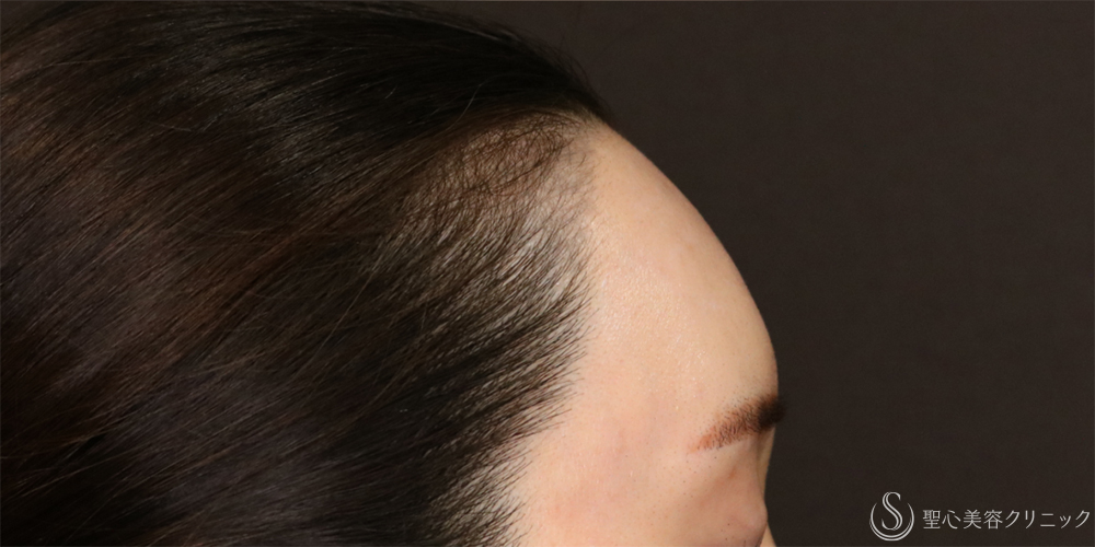 【30代女性・丸みのある額】プレミアムPRP皮膚再生療法（6年経過） After 