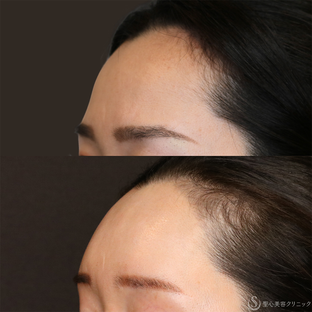 【30代女性・丸みのある額】プレミアムPRP皮膚再生療法（6年経過） After 