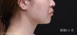 エラ張 フェイスラインを崩す「エラ張り」に悩む人が、いますぐやめる