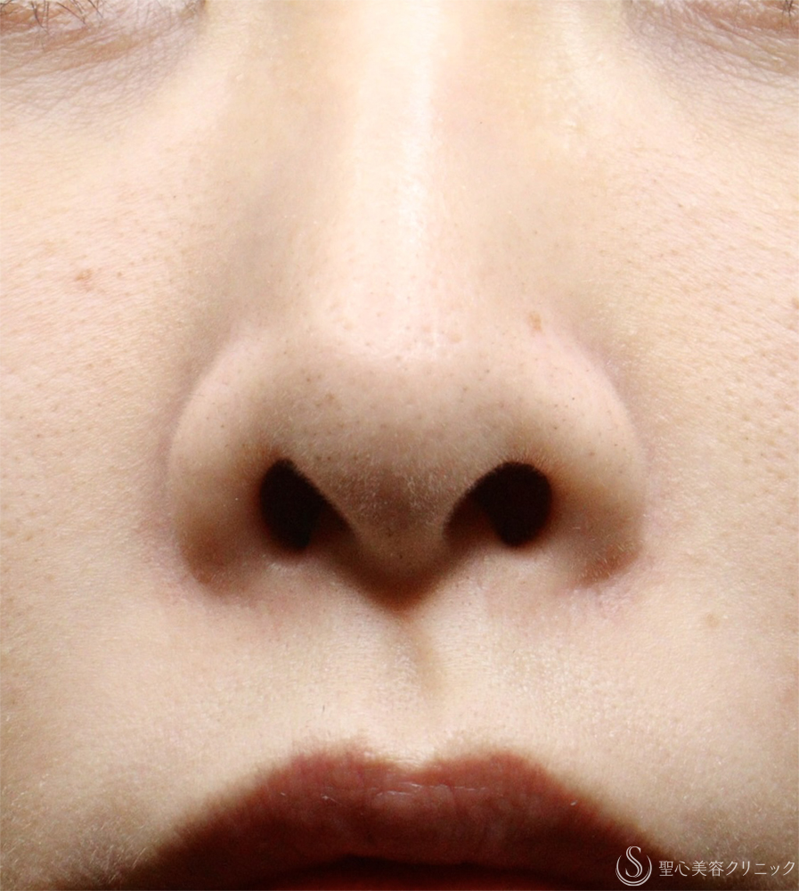 【30代女性・鼻の穴が見えるのが気になる】鼻孔縁下降術（1ヶ月） Before 