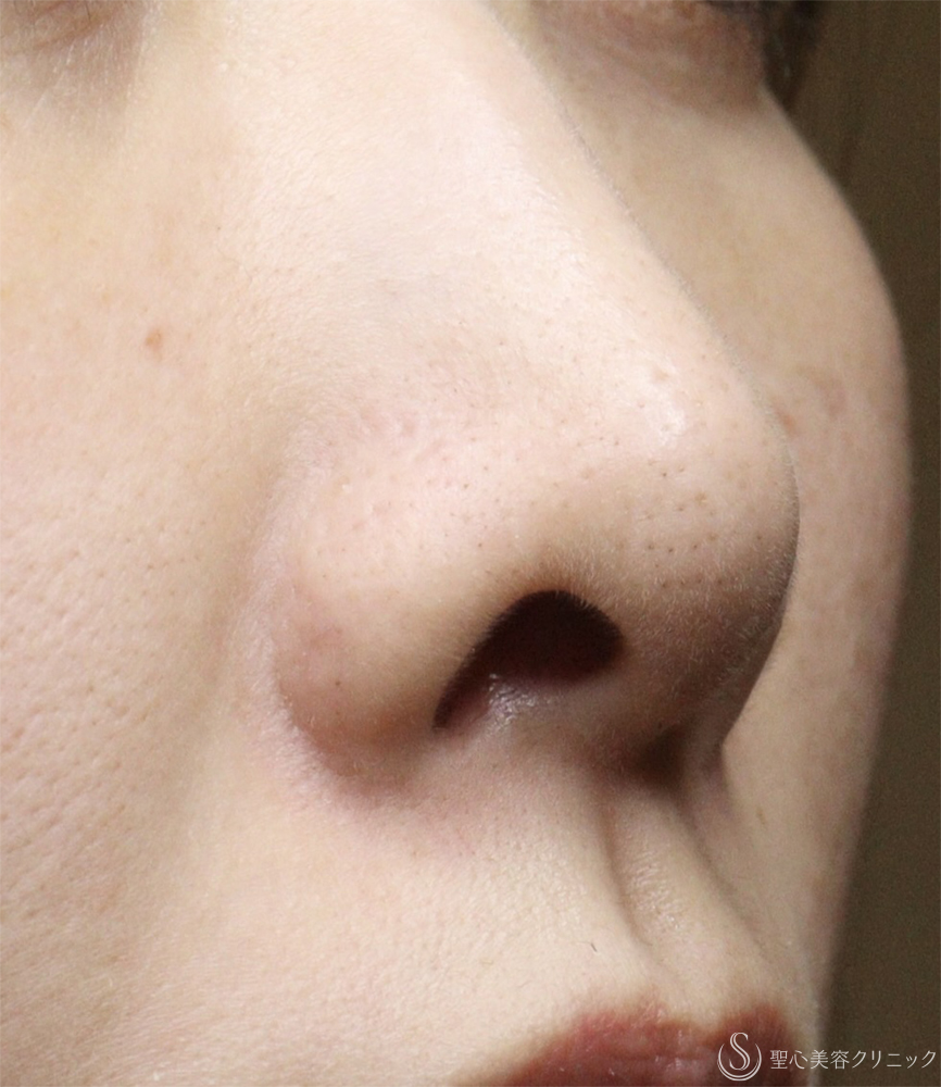 【30代女性・鼻の穴が見えるのが気になる】鼻孔縁下降術（1ヶ月） Before 