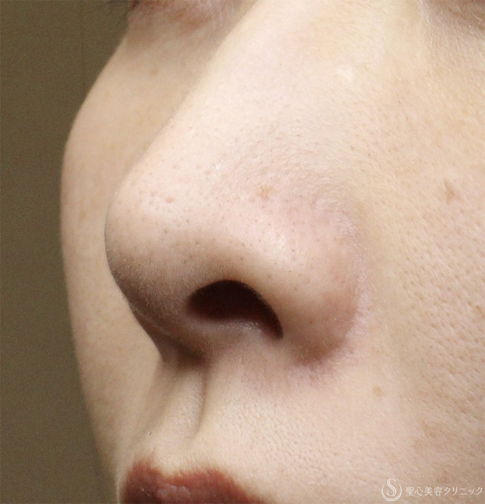 【30代女性・鼻の穴が見えるのが気になる】鼻孔縁下降術（1ヶ月） Before 
