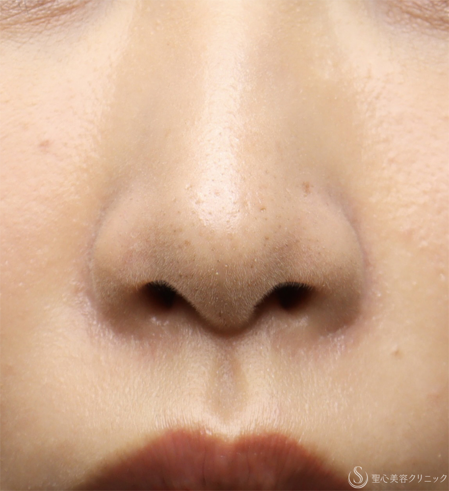 【30代女性・鼻の穴が見えるのが気になる】鼻孔縁下降術（1ヶ月） After 