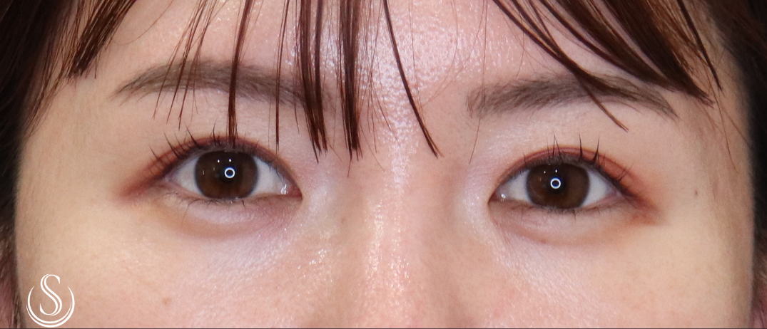 【30代女性・ナチュラルで華やかな目元に】ヒアルロン酸注入（涙袋）（2日後～10日後） After 