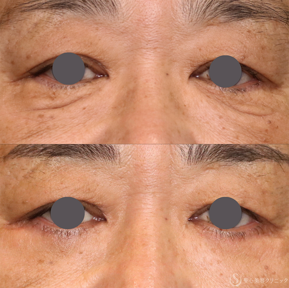 【50代男性・目の下を自然にすっきり】目の下のたるみ取り（2ヶ月後） After 名古屋・クマ・クマ取り・アンチエイジング