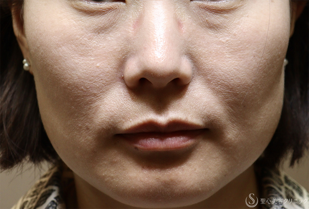 【40代女性・肌育で若返り】プレミアムPRP皮膚再生療法（半年後） Before 