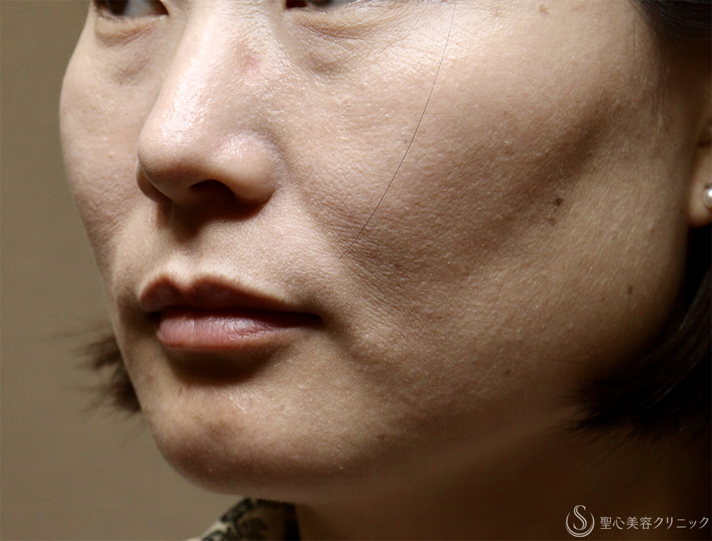 【40代女性・肌育で若返り】プレミアムPRP皮膚再生療法（半年後） Before 