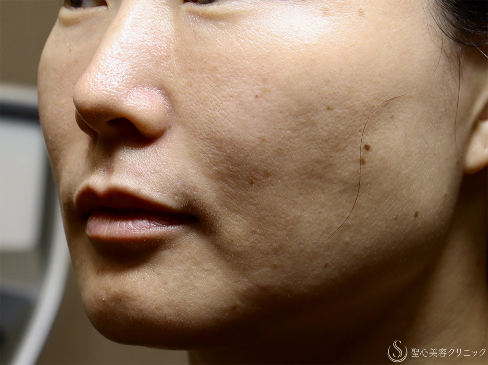 【40代女性・肌育で若返り】プレミアムPRP皮膚再生療法（半年後） After 