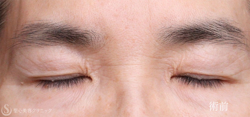 【60代女性・お目元のアンチエイジング施術でスッキリ瞼（まぶた）に】 眉下切開法（眉下リフト）＋ 目上切開（術後1ヶ月～3ヶ月） Before 