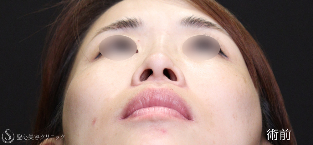 【30代女性・鼻尖縮小と小鼻縮小で忘れ鼻に】 鼻尖縮小＋ 小鼻縮小（1ヶ月後） Before 