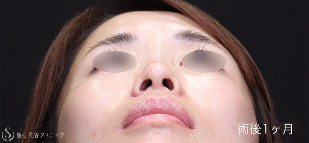 【30代女性・鼻尖縮小と小鼻縮小で忘れ鼻に】 鼻尖縮小＋ 小鼻縮小（1ヶ月後） After 
