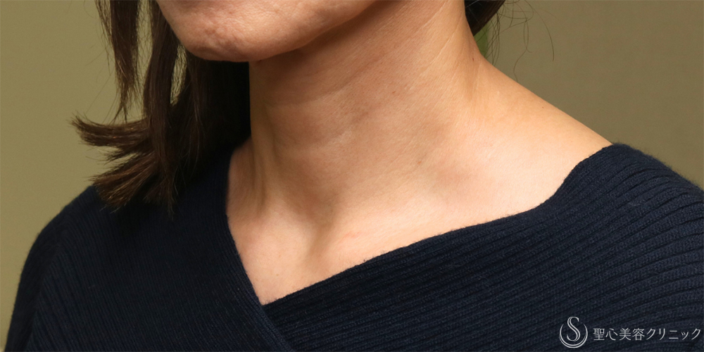 【60代女性・首の横ジワを改善】プレミアムPRP皮膚再生療法（1年後） Before 