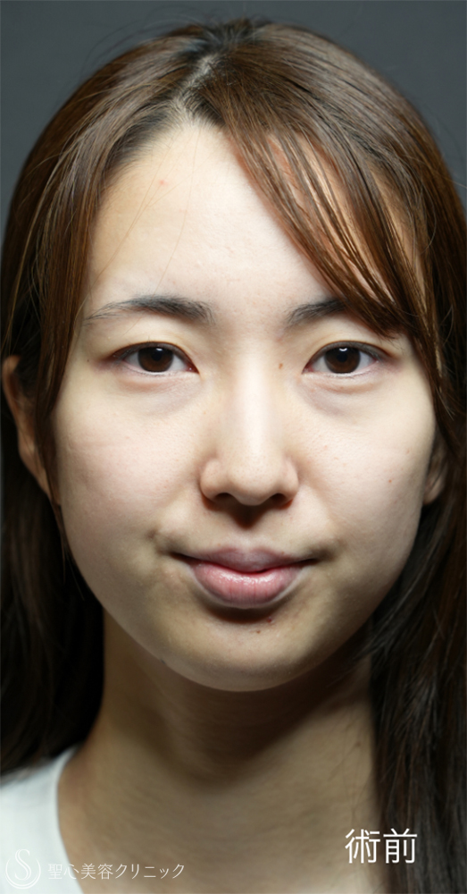 【20代女性・裏ハムラと二重埋没法で目元のナチュラルアップデート】下眼瞼切開術/下眼瞼除皺術/ハムラ法＋ 二重術（埋没法）：マイクロメソッド+α（1ヶ月後～1年後） Before 