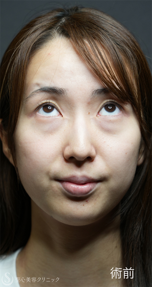 【20代女性・裏ハムラと二重埋没法で目元のナチュラルアップデート】下眼瞼切開術/下眼瞼除皺術/ハムラ法＋ 二重術（埋没法）：マイクロメソッド+α（1ヶ月後～1年後） Before 
