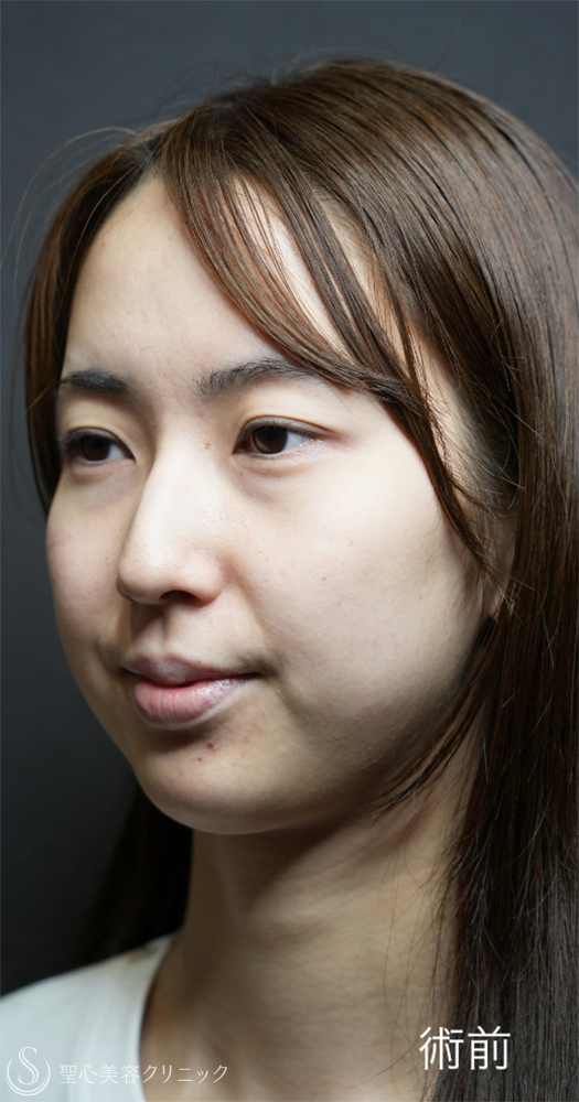 【20代女性・裏ハムラと二重埋没法で目元のナチュラルアップデート】下眼瞼切開術/下眼瞼除皺術/ハムラ法＋ 二重術（埋没法）：マイクロメソッド+α（1ヶ月後～1年後） Before 