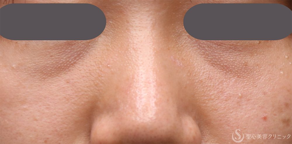 【20代女性・注射で目の下のくま取り】プレミアムPRP皮膚再生療法（目の下のくま）（1年後） Before 名古屋・目の下のくま・くま取り・くま治療