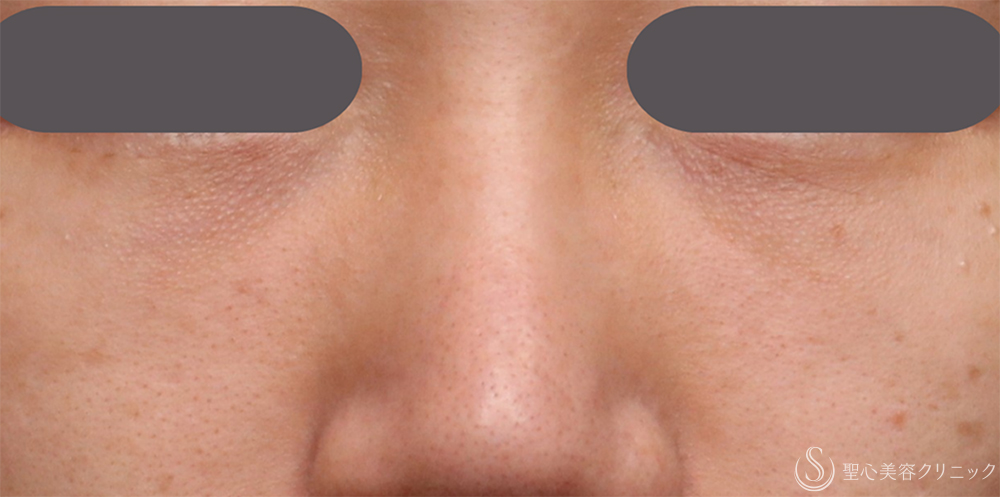 【20代女性・注射で目の下のくま取り】プレミアムPRP皮膚再生療法（目の下のくま）（1年後） After 名古屋・目の下のくま・くま取り・くま治療