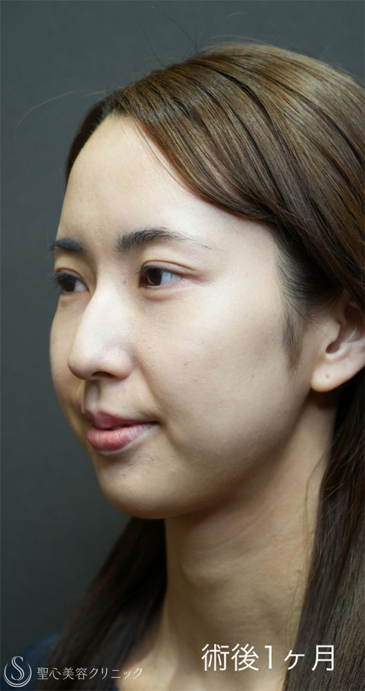 【20代女性・裏ハムラと二重埋没法で目元のナチュラルアップデート】下眼瞼切開術/下眼瞼除皺術/ハムラ法＋ 二重術（埋没法）：マイクロメソッド+α（1ヶ月後～1年後） After 