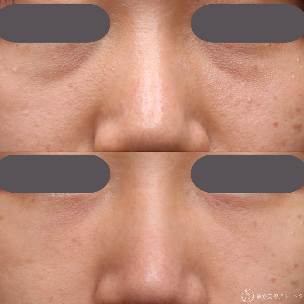 【20代女性・注射で目の下のくま取り】プレミアムPRP皮膚再生療法（目の下のくま）（1年後） After 名古屋・目の下のくま・くま取り・くま治療