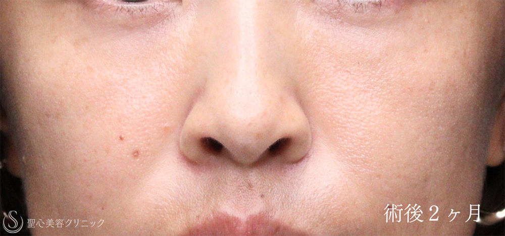 【30代女性・鼻の穴に丸みを】鼻孔縁下降術（術直後、術後2ヶ月） After 