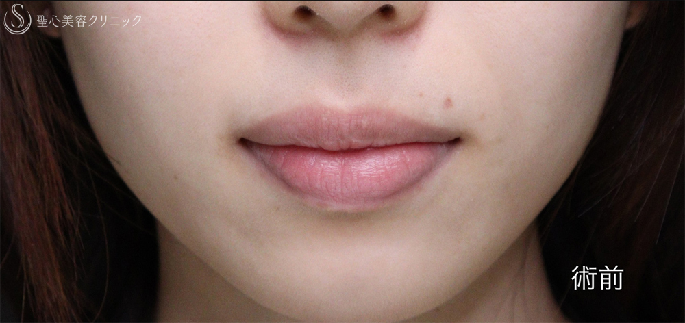 【20代女性・唇を薄くして上品な印象に】口唇縮小術（術後1週間～3ヶ月） Before 