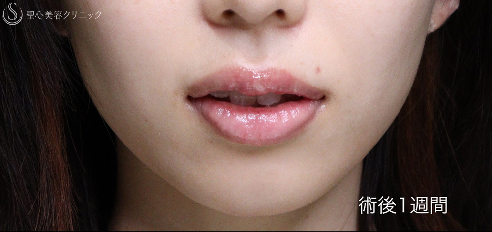 【20代女性・唇を薄くして上品な印象に】口唇縮小術（術後1週間～3ヶ月） After 