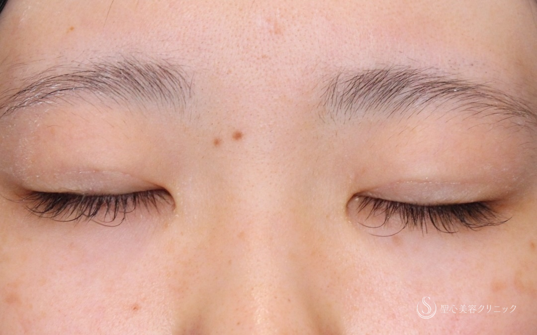 【20代女性・左右差を揃えナチュラル二重に】 二重術（埋没法）（1ヶ月後） After 