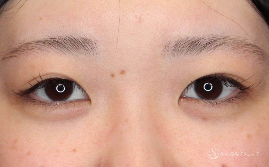 【20代女性・左右差を揃えナチュラル二重に】 二重術（埋没法）（1ヶ月後） Before 