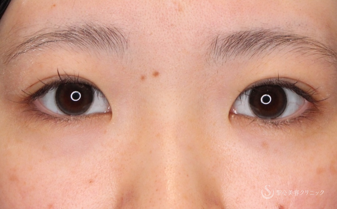 【20代女性・左右差を揃えナチュラル二重に】 二重術（埋没法）（1ヶ月後） After 
