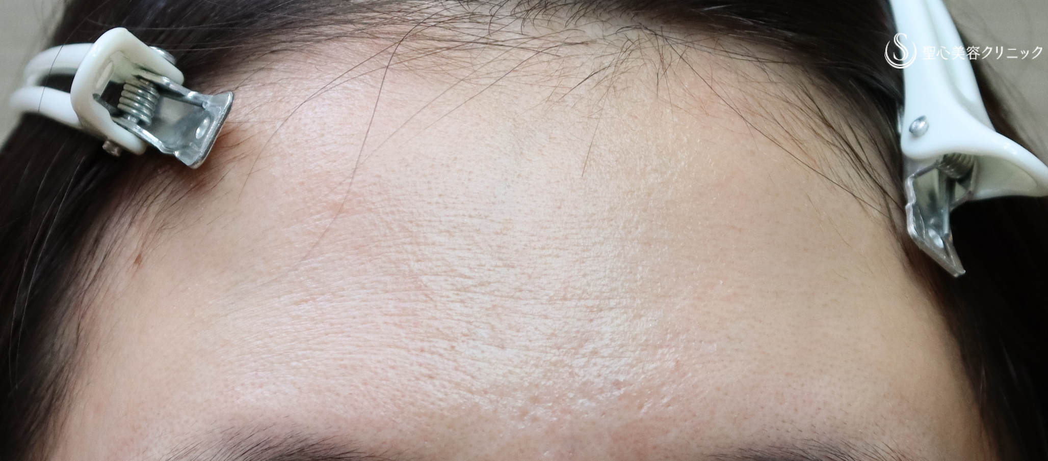 【30代女性・丸くてかわいいおでこに】プレミアムPRP皮膚再生療法（10ヶ月後） Before 