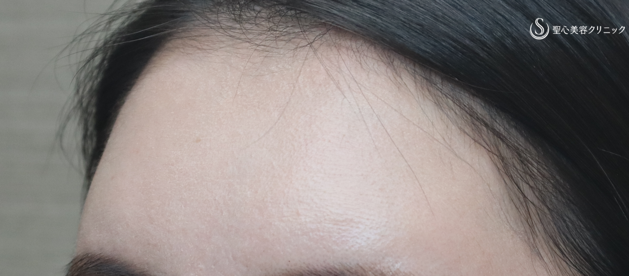 【30代女性・丸くてかわいいおでこに】プレミアムPRP皮膚再生療法（10ヶ月後） After 