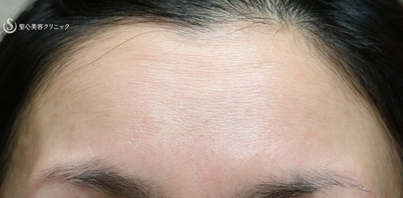 【30代女性・額のPRPの長期経過】 プレミアムPRP皮膚再生療法（3年後） Before 