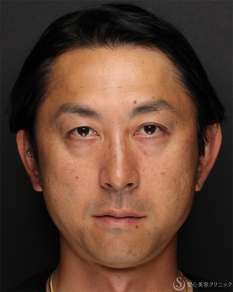 【40代男性・切らないクマ取り】目の下の脂肪取り（経結膜下脱脂法）（1ヶ月後） Before 