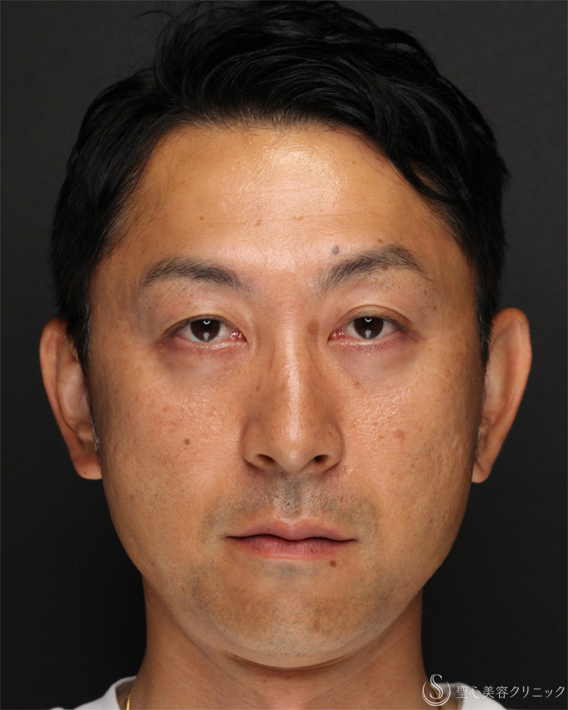 【40代男性・切らないクマ取り】目の下の脂肪取り（経結膜下脱脂法）（1ヶ月後） After 