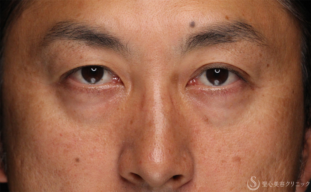 【40代男性・切らないクマ取り】目の下の脂肪取り（経結膜下脱脂法）（1ヶ月後） Before 