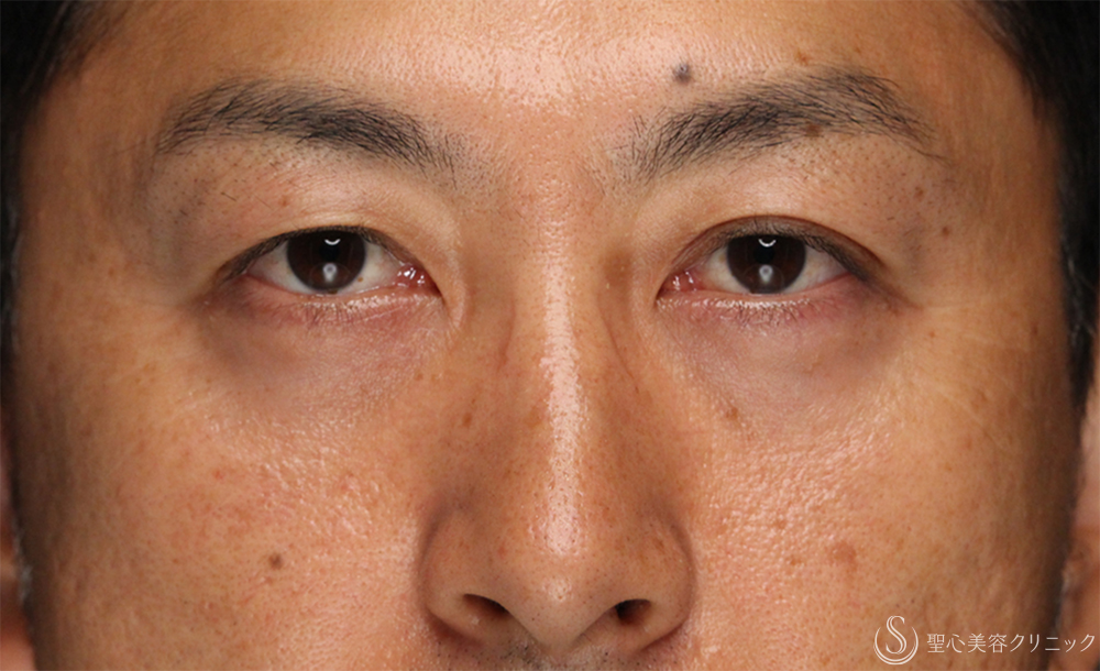 【40代男性・切らないクマ取り】目の下の脂肪取り（経結膜下脱脂法）（1ヶ月後） After 