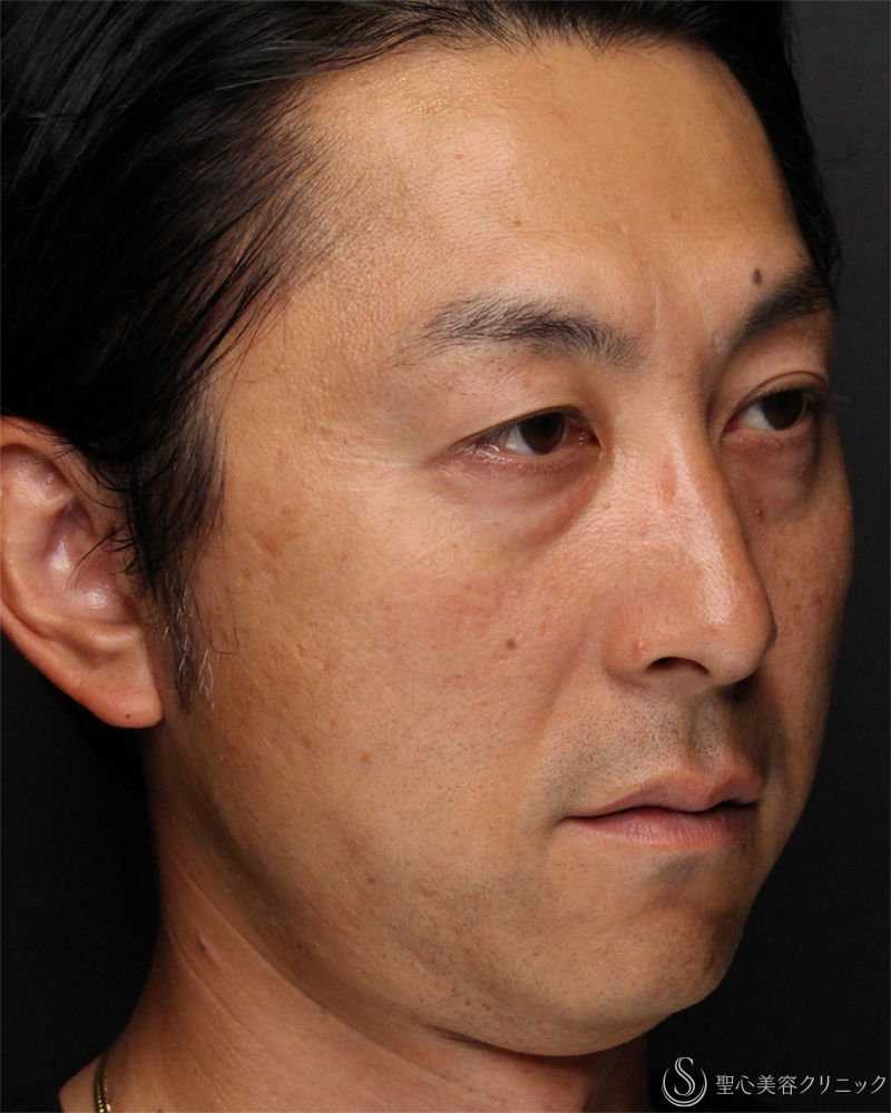 【40代男性・切らないクマ取り】目の下の脂肪取り（経結膜下脱脂法）（1ヶ月後） Before 