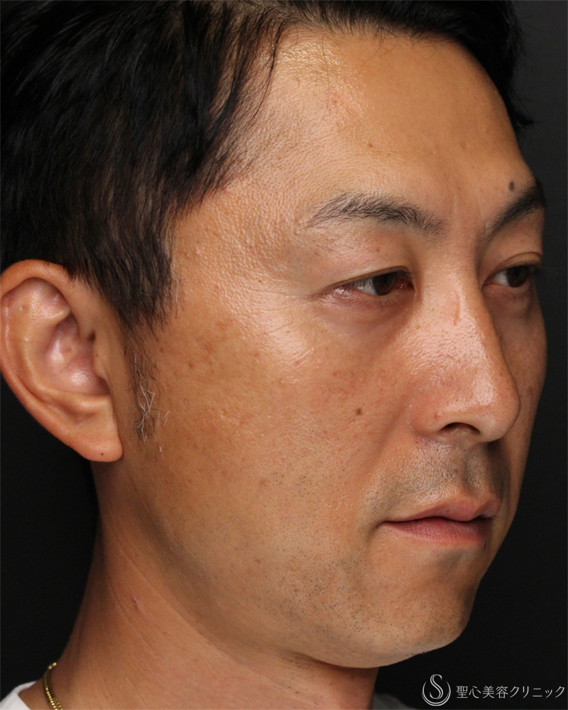 【40代男性・切らないクマ取り】目の下の脂肪取り（経結膜下脱脂法）（1ヶ月後） After 