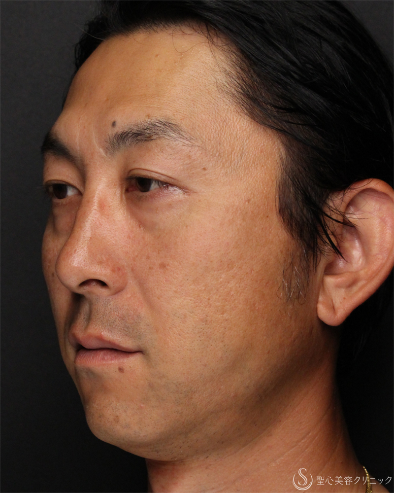 【40代男性・切らないクマ取り】目の下の脂肪取り（経結膜下脱脂法）（1ヶ月後） Before 