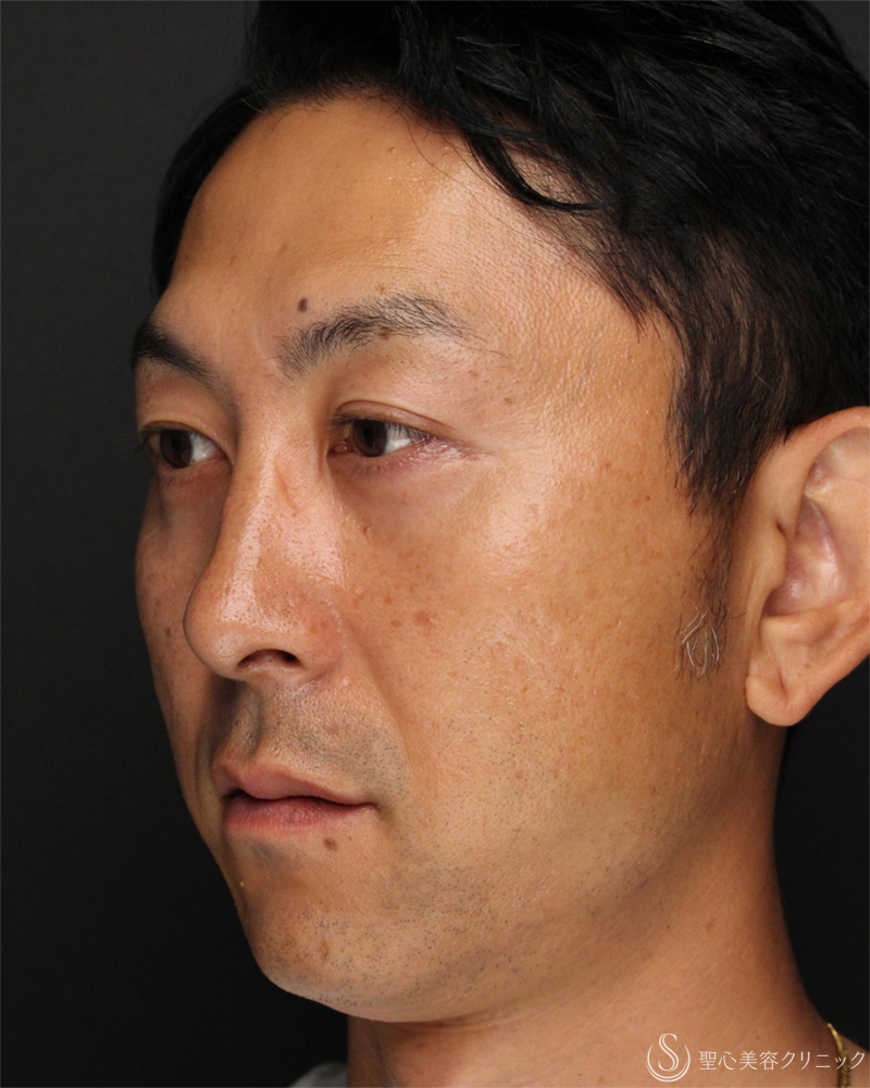 【40代男性・切らないクマ取り】目の下の脂肪取り（経結膜下脱脂法）（1ヶ月後） After 