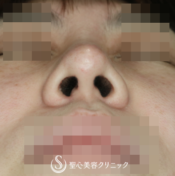 【30代女性・団子鼻の解消】鼻尖縮小+α（4ヶ月後） After 