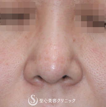 【30代女性・団子鼻の解消】鼻尖縮小+α（4ヶ月後） After 