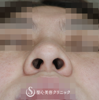【30代女性・団子鼻の解消】鼻尖縮小+α（4ヶ月後） Before 