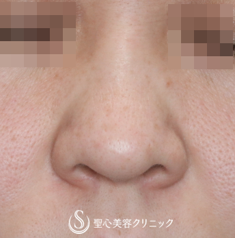 【30代女性・団子鼻の解消】鼻尖縮小+α（4ヶ月後） Before 