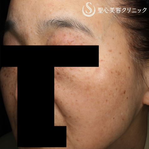 【50代女性・広範囲の肝斑を改善】トラネキサム酸錠（トランサミン酸錠）_シミ＋infact® ビューティーエナジーPQQプラス（医師監修のビタミンサプリメント）_美白・美肌（1ヶ月後） After 